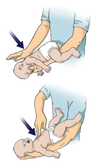 Two steps in performing choking rescue on a baby.