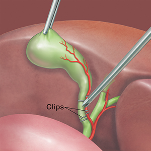 Cholecystectomy | Saint Luke's Health System