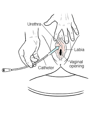 Fig: Inserting the catheter