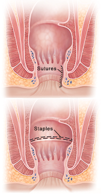 Surgery for Piles