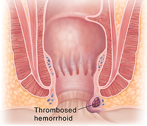 Cross section of anus showing thrombosed hemorrhoid.