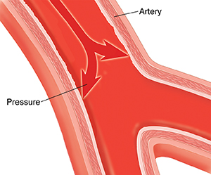 is high blood pressure a disease