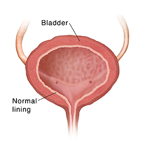 Interstitial cystitis is... 