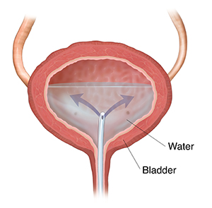 Cross section of bladder showing catheter inserted through ureter, releasing water into bladder.