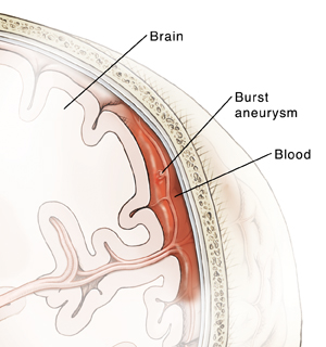 Subarachnoid Hemorrhage Symptoms & Treatment