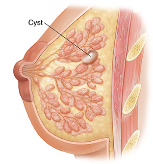 Doorsnede van borst met cyste en borstwand. 