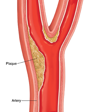 Carotid Artery Plaque: Pourquoi La Carotide Bouchée – JEBL