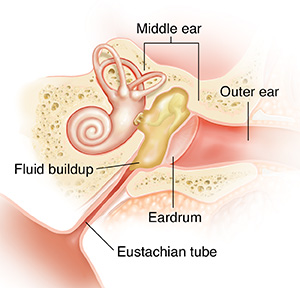 Understanding Middle Ear Infections In Children Saint Luke S Health System