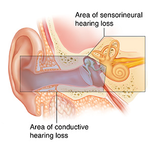 Permanent Damage In Middle Ear – DIMSO