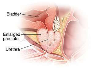 Benign Prostatic Hyperplasia Saint Luke s Health System