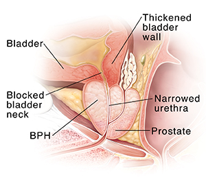 Cross section of enlarged prostate gland blocking urine in bladder.