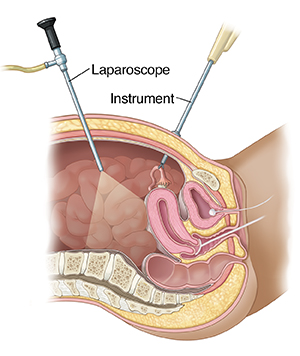 Photographs from laparoscopy showing: (A) internal bleeding