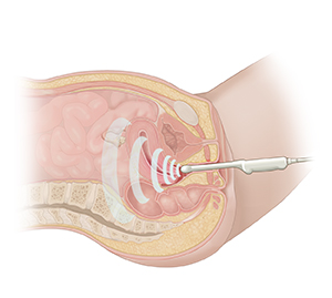 Pelvic Ultrasound Saint Luke S Health System