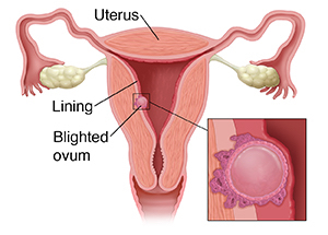 Understanding Blighted Ovum Saint Luke S Health System