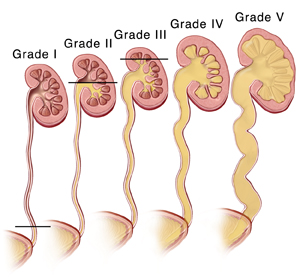 Enlarged kidneys in child