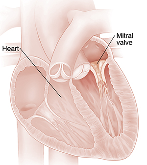 Cross section of heart showing mitral valve stenosis. 