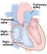 When Your Child Has Pulmonary Stenosis (PS) | Saint Luke's Health System