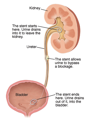 Ureteral Stents Saint Luke S Health System