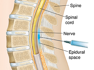 What Is Epidural Anesthesia Saint Luke S Health System