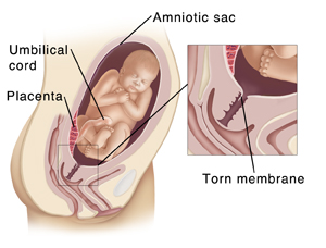 Pregnancy And Childbirth Premature Rupture Of The Membranes Prom Saint Luke S Health System