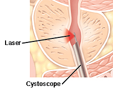 laser surgery for enlarged prostate)