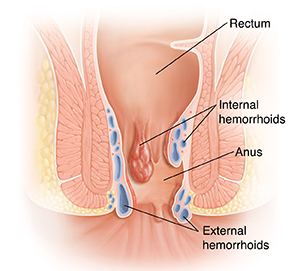 Hemorrhoids burning anus