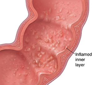 Featured image of post Colitis Flare Up Symptoms - But you may need to receive treatment for three to six weeks before you are free of symptoms.