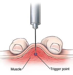 Painful Knotted Muscles? Trigger Point Injections Might Help