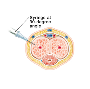 Saline Penis Injection