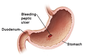 Cross section of stomach and duodenum showing peptic ulcer.
