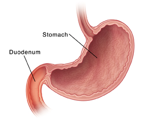 Duodenitis  Saint Luke's Health System