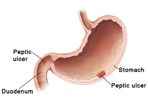 Cross section of stomach and duodenum. Sores in lining of stomach and duodenum are peptic ulcers.