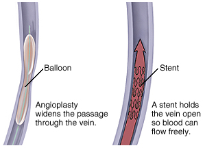 stint medical