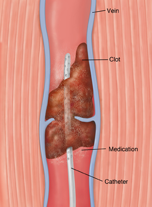 Clot buster — what is CLOT BUSTER definition 