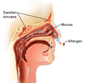 Nasal 2025 congestion allergies