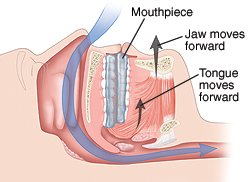 Mouthpieces for Sleep Apnea | Saint Luke's Health System