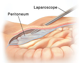 Hernia Repair (Laparoscopic Procedure for Abdominal Hernia)