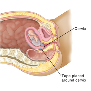 Tværsnit på siden af kvindens bækken, der viser, at barnet udvikler sig i livmoderen. Bånd er omkring livmoderhalsen for at holde den lukket.