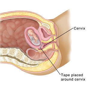 Mucus after miscarriage/incompetent cervix