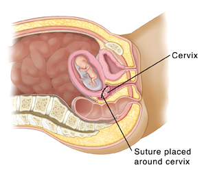 Pregnancy and Childbirth Transvaginal Cerclage Saint Luke s