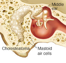 mastoidectomy types