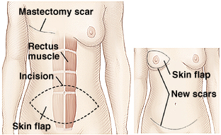 Front view of female breasts and abdomen showing TRAM flap breast reconstruction.