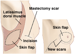 Front view of female breasts and abdomen showing LD flap breast reconstruction.