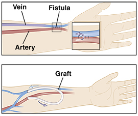 Vascular Hemodialysis Access | Saint Luke's Health System