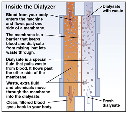 Hemodialysis | Saint Luke's Health System