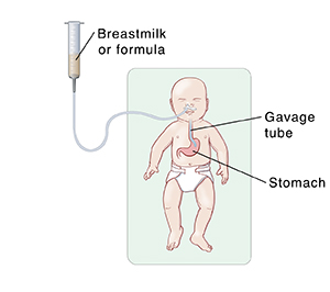 Diagram showing newborn lying on back being fed through gavage tube going from nose to stomach.