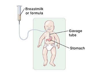 premature feeding