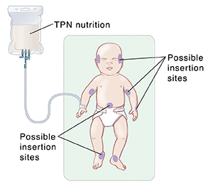 Diagram showing newborn lying on back with possible insertion sites for total parenteral nutrition (TPN).