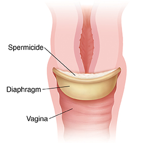 how to insert a diaphragm