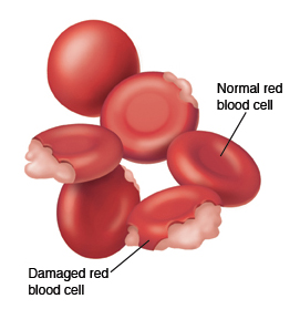  Hemolytic Anemia 